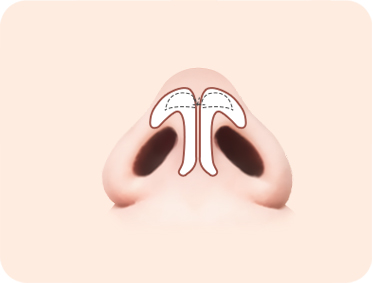 코끝(복코) 코끝 날개 연골이 큰 경우