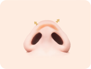 코끝(복코) 코끝의 피부가 두꺼운 경우
