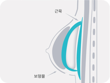 근육 하 삽입 (대흉근의 아래에 삽입)