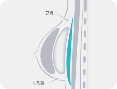 근막 하 삽입 (대흉근의 위에 삽입)