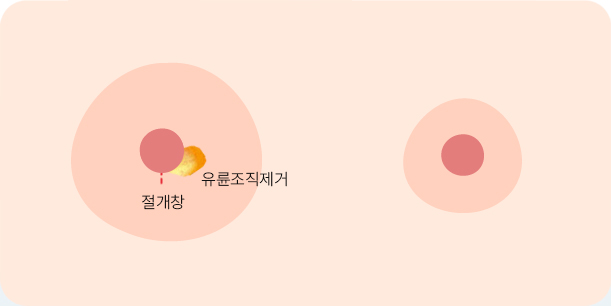 유륜축소술 방법