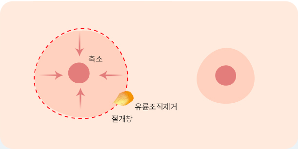 유륜축소술 방법